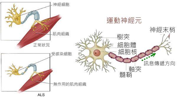 运动神经元病与遗传关系解析，是否会遗传？