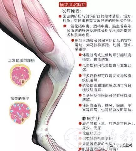 横纹肌溶解症的六个阶段全面解析