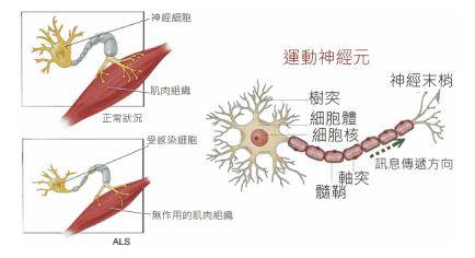 神经元病的早期症状详解及图片介绍