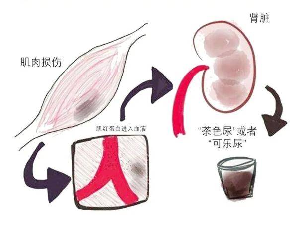 横纹肌溶解症早期症状识别与风险干预检查指南