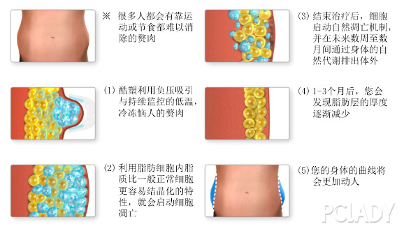 横纹肌溶解症状能否自愈？全面解析疑虑文章