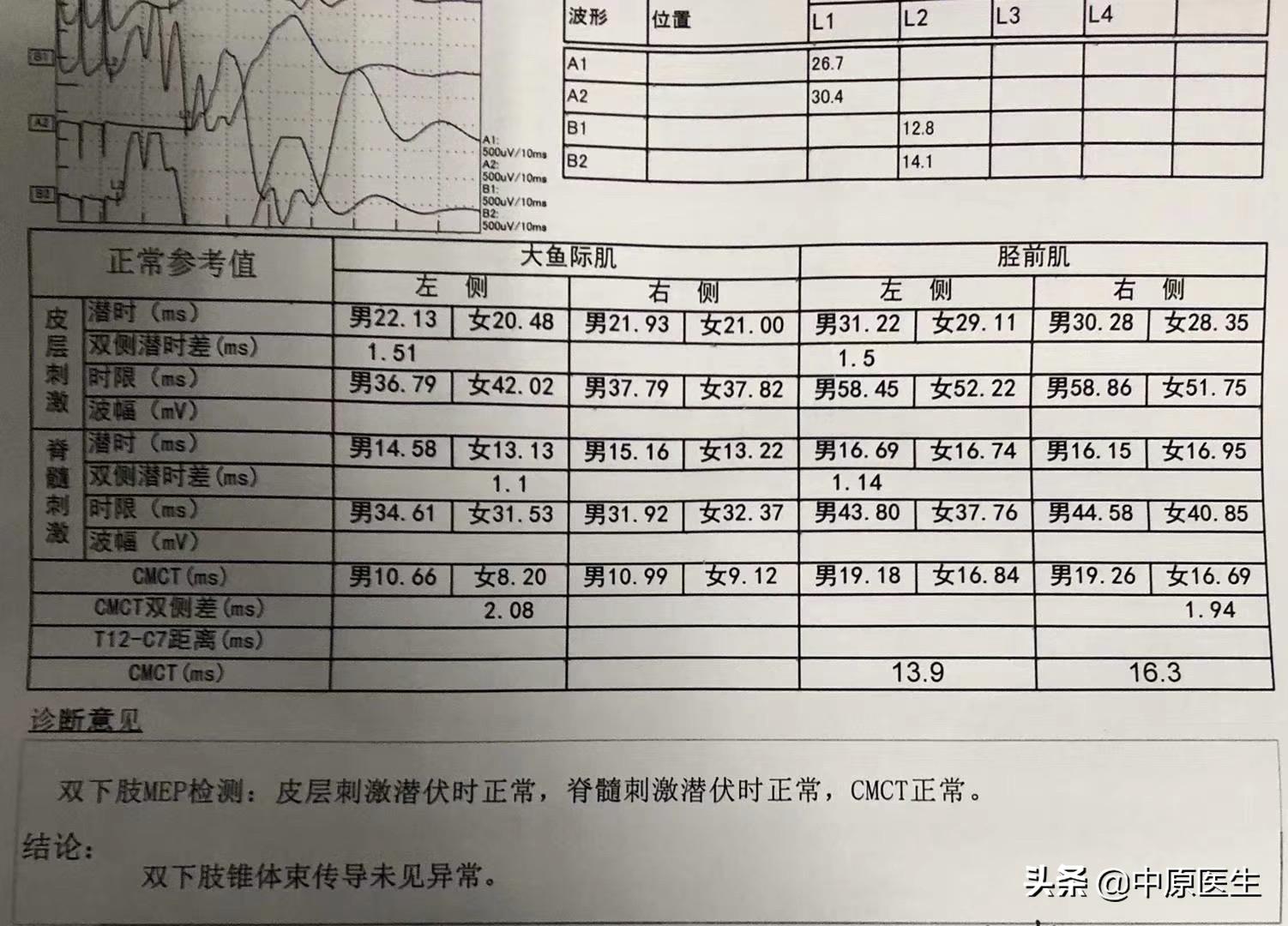 渐冻症早期症状解析及预防识别要点