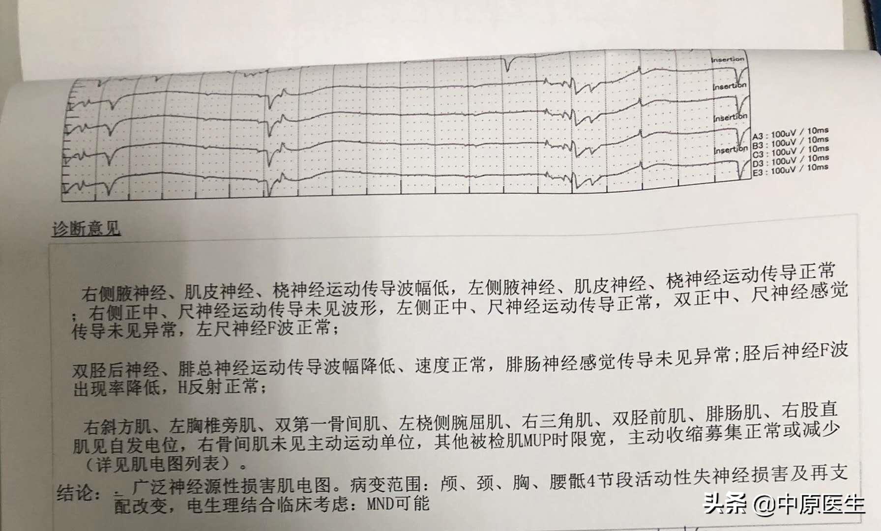 渐冻症早期征兆深度解析，上肢疼痛与应对建议