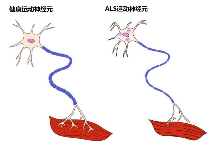 肌肉跳动背后的多元原因解读，并非一定是运动神经元病